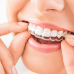 Clear Aligners – What You Need to Know Before Starting the Treatment