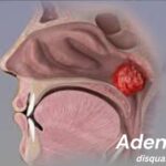 Adenoidid